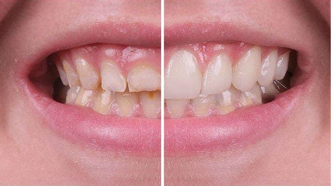 Gingival Estetik Düzenlemeler