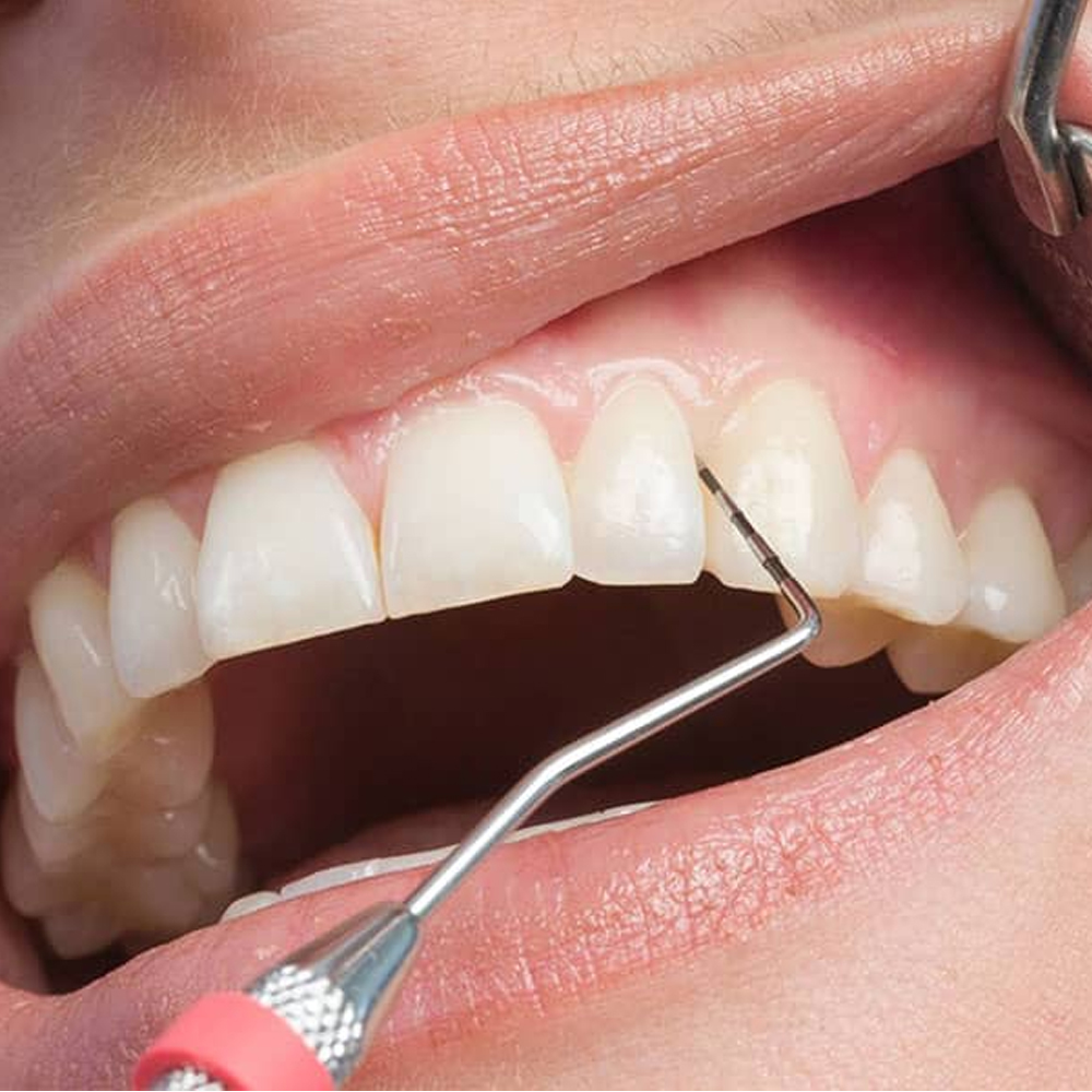 Periodontoloji (Diş Eti Hastalıkları Tedavileri)